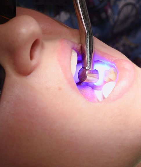 A dentist using a curing light on a patient’s tooth-colored resin