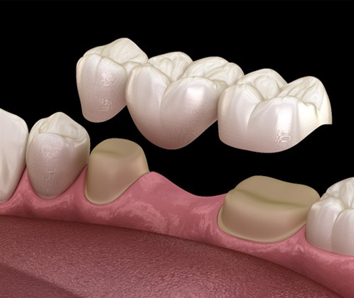 an illustration of a traditional dental bridge in Lakewood