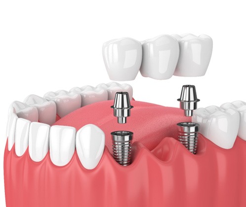an illustration of an implant dental bridge in Lakewood