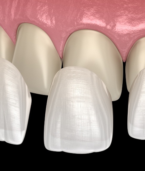 Animated smile during cosmetic dental bonding treatment