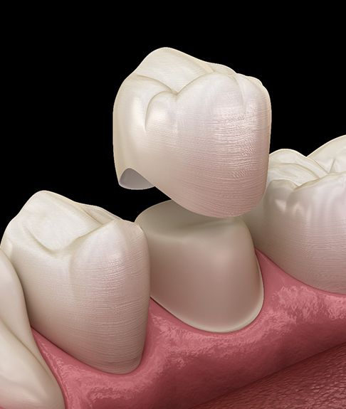 illustration of process for dental crowns in Lakewood