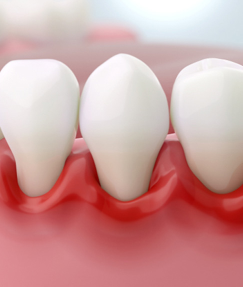 Illustration of red, inflamed gums