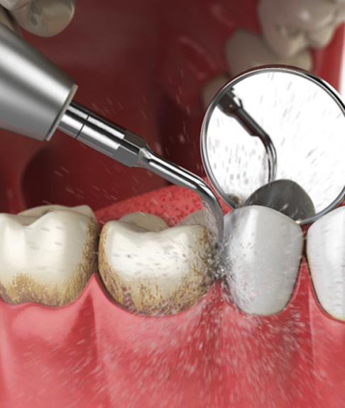 Illustration of teeth being cleaned