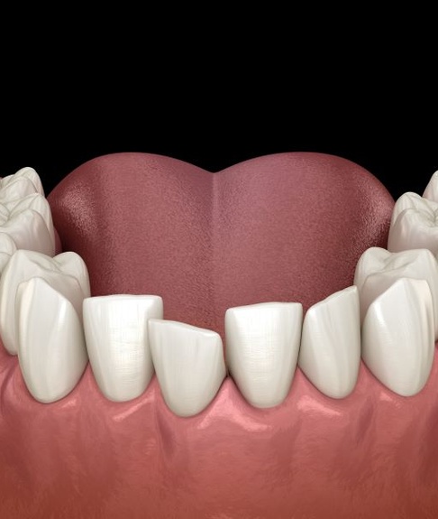 Illustration showing crowded, overlapping teeth