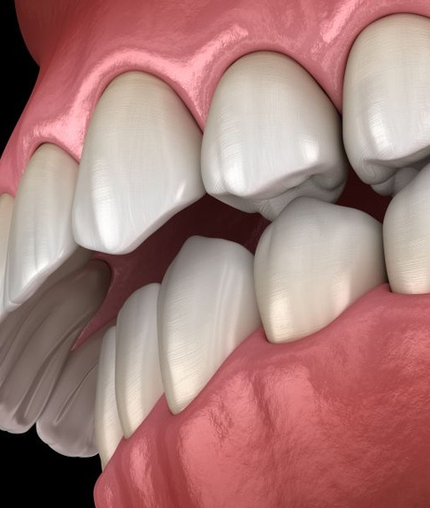 Illustration of significant overbite