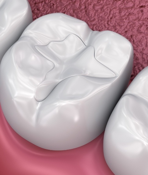 Animated smile with tooth colored filling after restorative dentistry