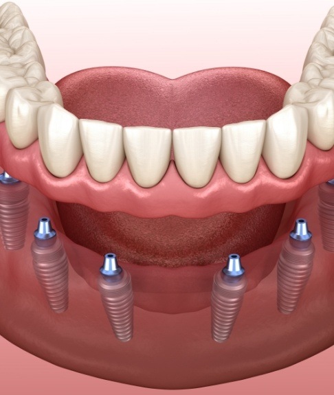 Animated smile during full mouth reconstruction